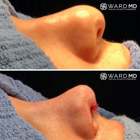 Nose Operation Before After, Nose Tip Surgery Before After, Rhinoplasty Inspiration, Rhinoplasty Before After, Nose Job Before And After, Nose Plastic Surgery, Nose Surgery Rhinoplasty, Beauty Job, Bulbous Nose