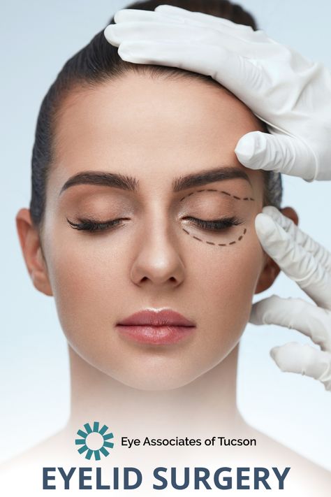 Belfaroplasty Eyes, Drooping Eyelid, Drooping Eyelids, Eyelid Lift, Clean Blackheads, Upper Eyelid, Under Eye Wrinkles, Skin Care Wrinkles, Eye Surgery