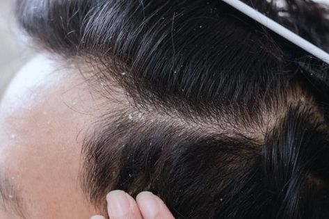 5 Natural Ways to Get Rid of Dandruff Once and For All How To Remove Dandruff, Dandruff Solutions, Home Remedies For Dandruff, Double Menton, Dandruff Remedy, Argan Oil Shampoo, Getting Rid Of Dandruff, Shaving Beard, Hydrating Shampoo