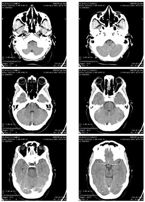 What is CT head and NCCT head? NCCT Scan: Purpose, Procedure & Price [2023] • BookmeriLab NCCT Head or brain full form is a non-contrast CT scan of the head. It is done to diagnose infarction, which is the usual cause of headaches, dizziness, seizures, tumours, stroke, haemorrhage, TIA, and trauma to the patient's bones. The doctor may recommend the use of Contrast material during the scan. Ct Scan, Best Poses For Pictures, Gcse Art, Viral Video, Radiology, The Doctor, Study Motivation, Headache, Art Sketchbook