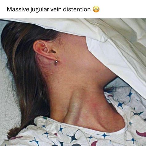 Learning about Jugular Venous Pressure and distention makes me think of this picture every time 😳 Comment below if you know some of the causes of jugular vein distention! . . . . . . #medstudent #medicalschool #medicalstudent #futurephysician #pediatrics #medicine #motivation #anatomist #medicalcase #medicalcases #healthcare #study #studygram #womeninmedicine #womeninstem #MCAT #USMLE #premed #doctor #surgeon #mbbs #cardiology #anatomy #healthcare #study #aesthetic #studentdoctor #medicalmem... Jugular Vein, Emt Study, Paramedic School, Nursing Assessment, Family Nurse Practitioner, Cardiac Nursing, Nursing School Studying, Medical School Studying, Medical School Essentials