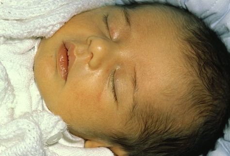 Babies Jaundice Skin - find a unique name for your new baby - femalebabynames.org Jaundice Remedies, Baby Jaundice, Preterm Baby, Premature Birth, Liver Failure, Homeopathic Medicine, Baby Skin Care, Brain Damage, Chronic Disease