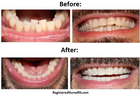 Clear Aligner Braces Before and After Overjet Overbite, Hawley Retainer, Braces Before And After, Clear Aligner, Clear Braces, Dental Fillings, Crooked Teeth, Pictures Tips, Clear Aligners