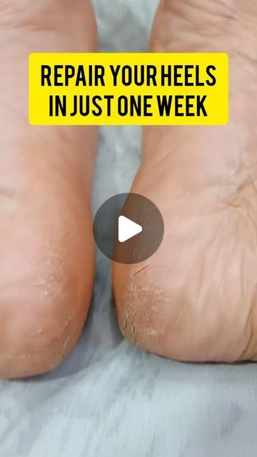 Home Remidies on Instagram: "Now repair your crack heels. Follow @homeremidies202 for more #skincaretips #home #skin #trending #follow4followback #fyp" Heel Cracks Remedies, Cracked Heels Remedy, Cracked Heel Remedy, Potato For Skin, Cracked Heel Remedies, Viral Skincare, Skincare Selfcare, Foot Scrub, Cracked Heels