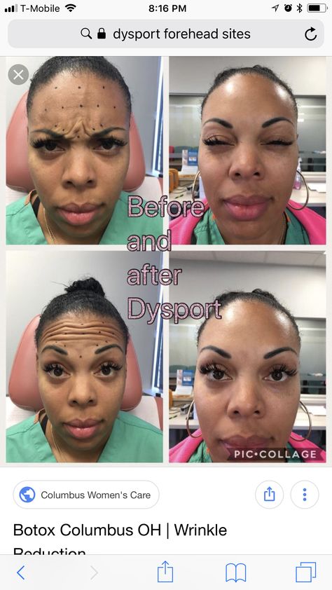 Botox Injection Points, Botox Placement Chart, Botox Areas On Face, Baby Botox Before And After, Armonizacion Facial, Where To Get Botox On Face, Face Fillers Before And After, Jaw Botox Before After, Botox Jawline Before And After