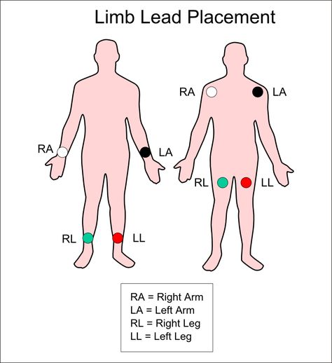 4 Lead ECG placement: Smoke over Fire, Clouds over Grass      Medictests.com - EMT and Paramedic Practice Tests Online! National Registry Test Prep! Check out our entire library of study resources and NREMT tests! Paramedic Cheat Sheet, Ems Assessment Cheat Sheets, Emt Worksheets, Emt National Registry Study, Emt Basic Study Test Prep, Ekg Notes, National Registry Paramedic Study, Ekg Placement, Emt Cardiac Emergencies