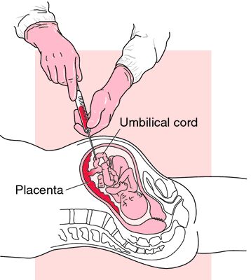 cordocentesis Medical Dictionary, Medical Terms, Free Tools, Medical, Quick Saves