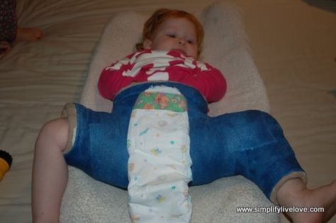 Diapering a spica cast... Spica Cast, Nursing Knowledge, Baby Cast, Hip Surgery, Hip Dysplasia, Surgery, Nursing, It Cast, Health