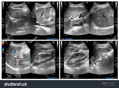 Ultrasound upper abdomen show Liver,Pancreas and boht Kidneys appear.abdomen#show#Ultrasound#upper Ultrasound, Royalty Free Photos, Voss Bottle, Design Art, Photo Editing, Photoshop, Stock Photos, Graphic Design, Design