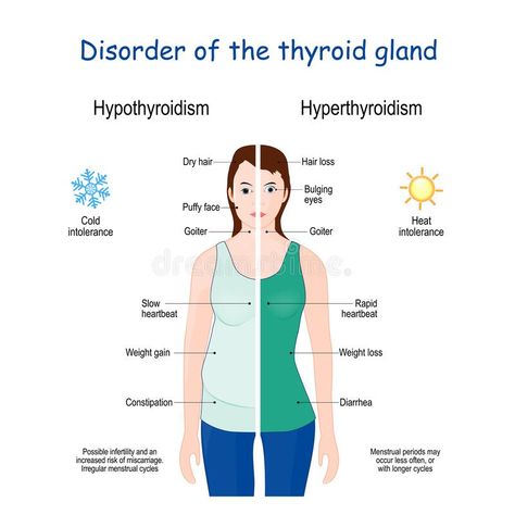 Hyperthyroidism and Hypothyroidism. Female with Signs and symptoms of different thyroid gland diseases stock illustration Diseases Illustration, Thyroid Levels, Irregular Menstrual Cycle, Thyroid Test, Healthy Book, Low Thyroid, Thyroid Medication, Thyroid Function, Thyroid Gland