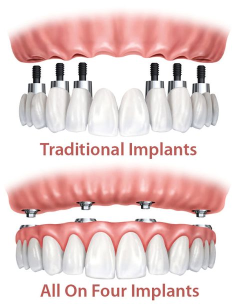 Dental Images, Dental Implant Procedure, Denture Implants, Best Dental Implants, Dental Implant Surgery, Dental Implants Cost, Implant Dentistry, Emergency Dentist, Teeth Implants