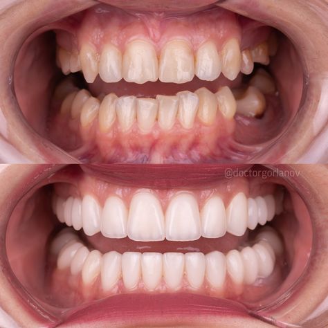 Perfect Natural Teeth, Dental Bonding Before And After, Teeth Before And After, Dental Before And After, Teeth Bonding Before And After, Teeth Transformation, Perfect Teeth Smile, Natural Veneers, Kate Richards