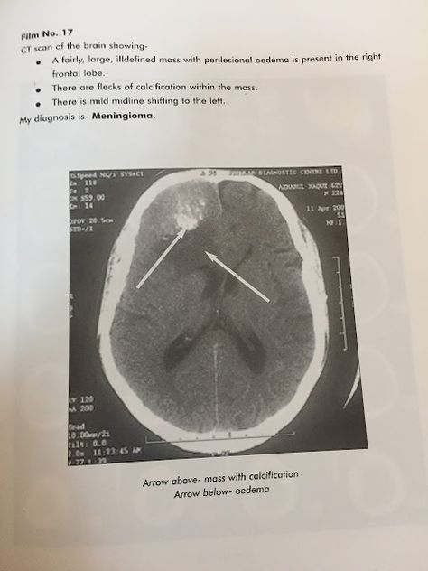 CT SCAN OF BRAIN-9 Brain Tumour Fake Report, Ct Scan Brain, Food Chain Worksheet, Brain Problems, Radiologic Technology, Mri Brain, Brain Test, Brain Scan, Mri Scan