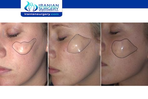 How long do cheek implants last?| Cheek implants| types of cheek implants Cheek Implants Before And After, Neck Lift Surgery, Cheek Implants, Silicone Implants, Face Lift Surgery, Reduction Surgery, Fat Transfer, Neck Lift, Brow Lift