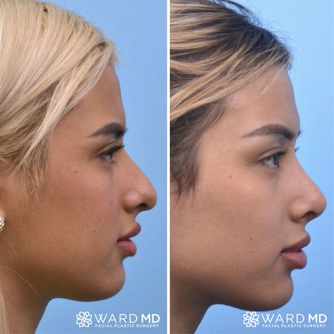 Nose Operation, Jaw Surgery, Rhinoplasty Nose Jobs, Nose Surgery, Nose Job, Plastic Surgeon, Plastic Surgery, Surgery, Fashion Makeup