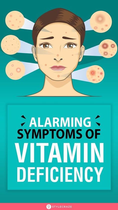 Live A Healthy Lifestyle, B12 Deficiency, Vitamin B12 Deficiency, Vitamin Deficiency, Vitamin D Deficiency, Health Signs, A Balanced Diet, Vitamin B12, Lose 50 Pounds