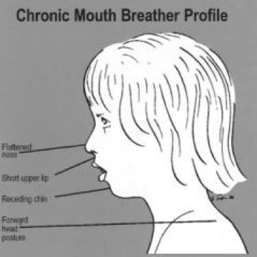 How breathing through your mouth can affect your health Buteyko Breathing, Orofacial Myofunctional Therapy, Nose Surgery Rhinoplasty, Tongue Thrust, Slp Organization, Mouth Breathing, Myofunctional Therapy, Oral Pathology, Mouth Breather