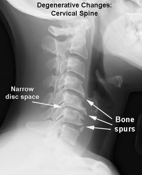 #Cervical #spondylosis most often causes #neck #pain and #stiffness.  Don't sit still for joint pain! Learn the steps, stretches, and moves that will keep you on the go and in the game.To your good #health Spinal Degeneration, Spine Problems, Vertebral Artery, Cervical Pain, Cervical Spondylosis, Referred Pain, Hip Problems, Spinal Nerve, Bone Diseases