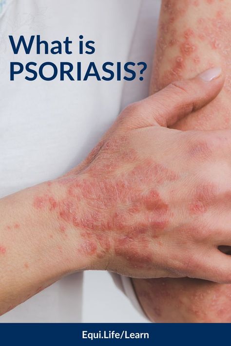 Psoriatic Skin, Skin Patches, Functional Food, Mental Health Disorders, Skin Disorders, Scalp Conditions, Skin Care Remedies, Itchy Skin, Skin Issues