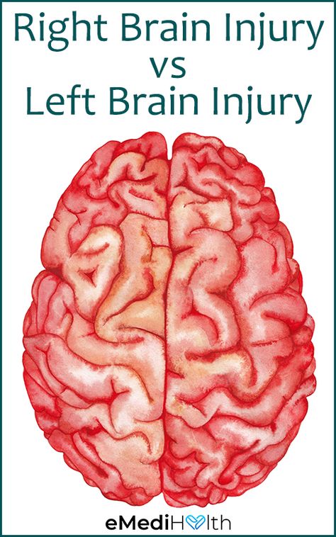 Brain Bleed Recovery, L Tyrosine Benefits, My Beautiful Broken Brain, Vitamin Sources, Brain Recovery, Brain Surgery Recovery, Traumatic Brain Injuries, Brain Issues, Left Brain Right Brain