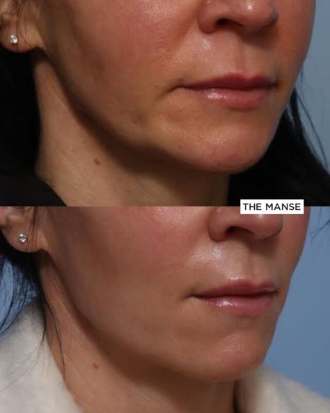 Ask for thicker, fillers to recreate jawline, to only undertake once a year. Jawline Dermal Filler - Best Clinic Sydney for Dermal Fillers Filler Around Mouth, Nasolabial Folds Dermal Fillers, Marionette Lines Filler, Jaw Filler, Nasolabial Fold Filler, Lines Around Mouth, Chin Filler, Marionette Lines, Tear Trough