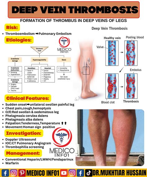 DVT #medicoinfo1 #medical #medicalstudent #medicalschool #medicine #medico #mbbs #mbbsstudent #mednotes #pharmacology #physiology #pathology #anatomy #microbiology #health #usmle #doctor #nurse #futuredoctor #doctorsofinstagram #hospital #healthcare Dvt Nursing, Pharmacology Nursing Study, Medicine Motivation, Nursing School Success, Medicine School, Crna School, Medical Images, Nurse Skills, Bells Palsy