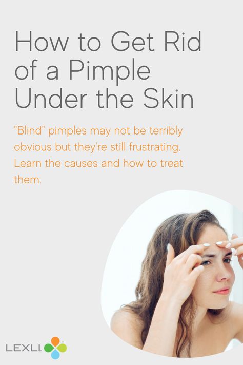 Graphic shows a woman trying to pop a pimple and the headline, "How to Get Rid of a Pimple Under the Skin." Painful Pimple Under Skin, Painful Pimple, Pimple Causes, Different Types Of Acne, Blind Pimple, Skin Care Advice, Pimples Under The Skin, Under The Skin, Types Of Acne