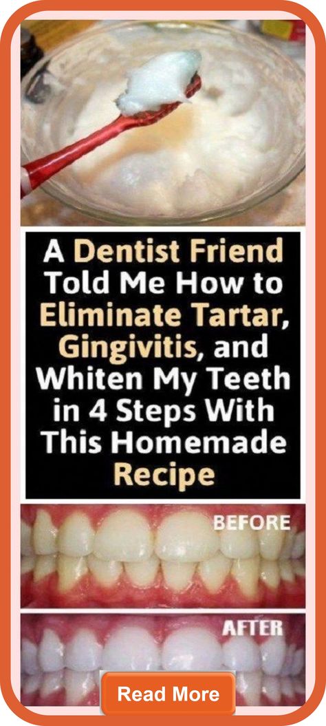 BE YOUR OWN DENTIST! HERE ARE TRICKS TO REMOVE TARTAR BUILDUP AT HOME Heal Cavities, Teeth Health, Homemade Recipe, Oral Health Care, Tooth Decay, Oral Health, Health Remedies, Herbal Remedies, Cavities