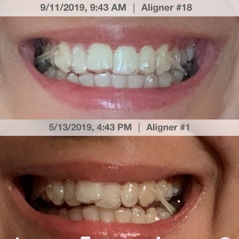 Invisalign Gems, Braces Vs Invisalign, How To Clean Invisalign Retainers, Invisalign Braces, Invisalign Memes, Body Mods, Lokai Bracelet, Live Lokai Bracelet