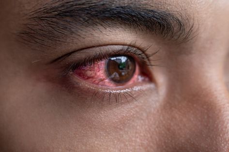 What Causes Red Eyes, Bloodshot Eyes, Swollen Eyes, Eye Meaning, Irritated Eye, Itchy Eyes, Eyes Problems, Health Skin Care, Pink Eyes