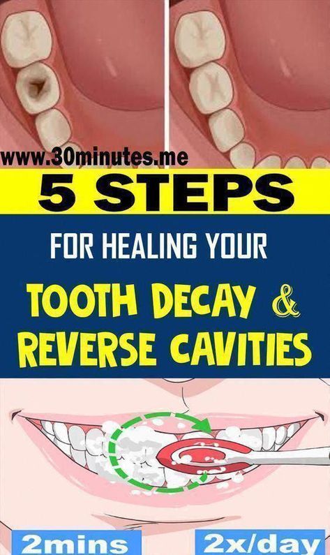 5 Steps For Healing Your Tooth decay And Reverse Cavities – New Healthy Life Now #HowToTakeCareOfOralHealth #WhatIsOralCareSystem #TakeCareOfOralHealth #OralCare #WhyIsOralHealthCareImportant #WhyIsOralCareSoImportant #WhatAreTheOralCareTips #WhatIsTheBestOralCareRoutine #WhatIsThePurposeOfOralCare #WhatIsPrimaryOralHealthCare #WhyIsOralCareImportantInHospitals Reverse Cavities, Dental Cavities, Oral Care Routine, Periodontal Disease, Receding Gums, Oral Health Care, Tooth Decay, Oral Hygiene, Dental Health