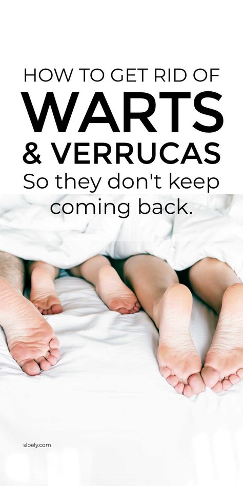 Learn how to get rid of warts and verrucas so they don't come back. These simple home remedies remove warts and verrucas and prevent them returning. #getridofwarts #warts #wartremedy #removewarts Verruca Removal, Don't Come Back, Home Remedies For Warts, Warts Remedy, Remove Skin Tags Naturally, Wart Remover, Remove Warts, Natural Remedies For Migraines, Get Rid Of Warts