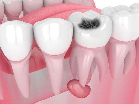 alexandrpattison.wordpress.com Abscess Tooth, Cosmetic Dentistry Procedures, Tooth Cavity, Dental Cavities, Dental Emergency, Pediatric Dental, Restorative Dentistry, Teeth Implants, Pediatric Dentist