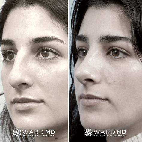 Rhinoplasty Side Profile, Nosejob Rhinoplasty Before After, Greek Nose, Refined Tip Rhinoplasty, Revision Rhinoplasty, Ethnic Rhinoplasty, Kpop Plastic Surgery, V Line Surgery, Jaw Reduction Surgery