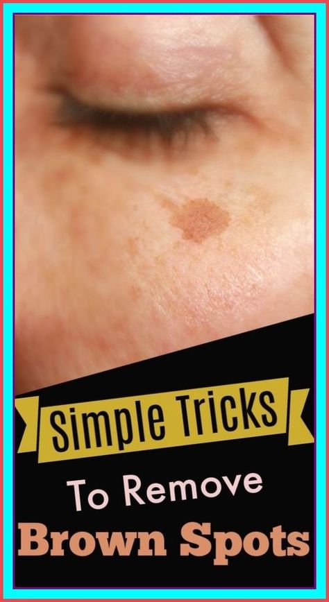 There is nothing scary with having a few brown spots, also known as age spots, but... Brown Spots On Hands, Brown Age Spots, Age Spot Removal, Brown Spots On Skin, Brown Spots Removal, Brown Spots On Face, Skin Spots, Spots On Face, Brown Spots