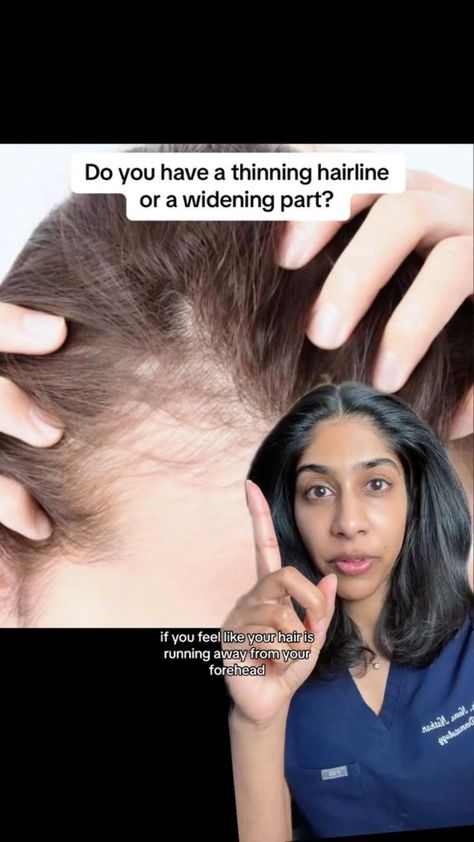 Hair Repair Secrets Hair Growth Tips For Bald Spots, Help Thinning Hair Remedies, How To Fix Hairline Women, Hair Regrowth Before And After, Stop Hair From Falling Out, Hair Growth Tips For Thinning Hair, Hair Growth For Fine Hair, Hormonal Hair Thinning, Why Is My Hair Thinning