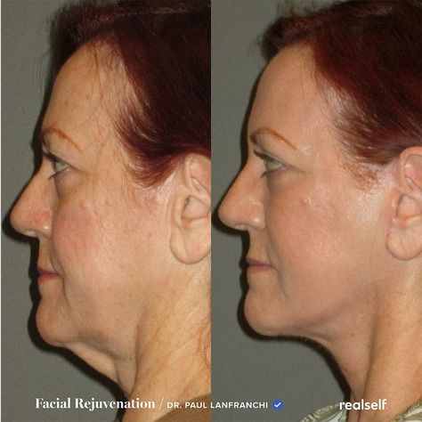 The term turkey neck refers to loose, sagging, wrinkled skin located underneath the jawline, on the neck. Get Rid Of Turkey Neck, Loose Neck Skin, Neck Lift Surgery, Defined Jawline, Facial Procedure, Laser Resurfacing, Turkey Neck, Lower Third, Plastic Surgery Procedures