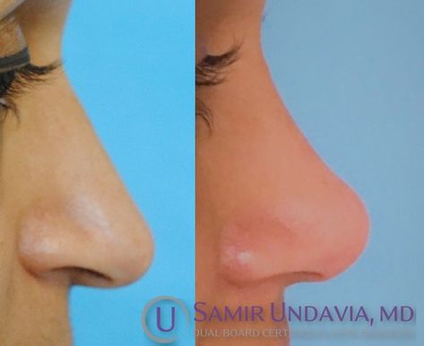 Droopy Tip Nose Rhinoplasty, Droopy Nose Aesthetic, Droopy Nose, Dream Nose, Nose Jobs, Rhinoplasty Nose Jobs, Healthy Heart Tips, Nose Surgery, Migraine Headaches