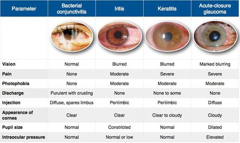 MEDICAL SCHOOL: iritis vs conjunctivitis vs keratitis Opthalmic Technician, Optometry Education, Optometry School, Eye Facts, Eye Anatomy, Eye Chart, Medical School Studying, Healthy Eyes, Eyes Problems