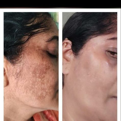 Micronidelling Face, Hair Surgery, Dark Spots On Face, Face Patches, Genetic Disorders, Spots On Face, Fade Dark Spots, Remove Dark Spots, Classy Photography