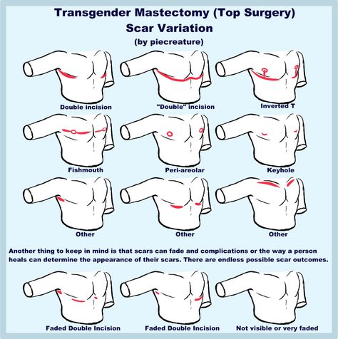 Sylar 🔪 on Twitter: "I usually see people giving their post op trans characters the same "standard" double incision scars. I thought I'd draw up some examples showing that there's tons of different outcomes a person can get from top surgery! They're actually tons of fun to mess around with!!… https://t.co/G1WPgvc7dI" Trans Characters Art, Trans Masc Top Surgery, Trans Dysphoria Drawing, Top Surgery Scars Aesthetic, Demiboy Art, Top Surgery Drawing, Trans Drawings Ftm, Trans Top Surgery, Top Surgery Art