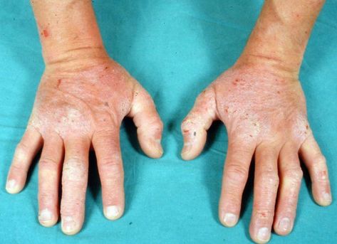 Gluten Allergy Rash, Rash On Hands, Allergy Rash, Rash Causes, Gluten Allergy, Itching Skin, Skin Hand, Skin Diseases, Food Allergies