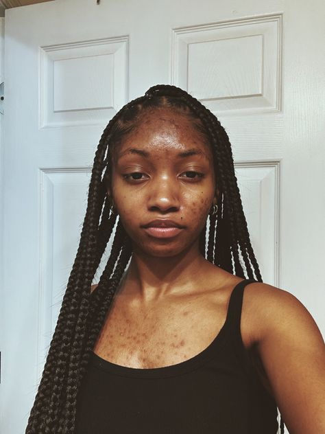 Natural Bare Face, Acne Black Women, Acne Appreciation, Acne Awareness, Girl With Acne, Acne Positivity, Acne Women, Big Nose Beauty, Pimples On Face