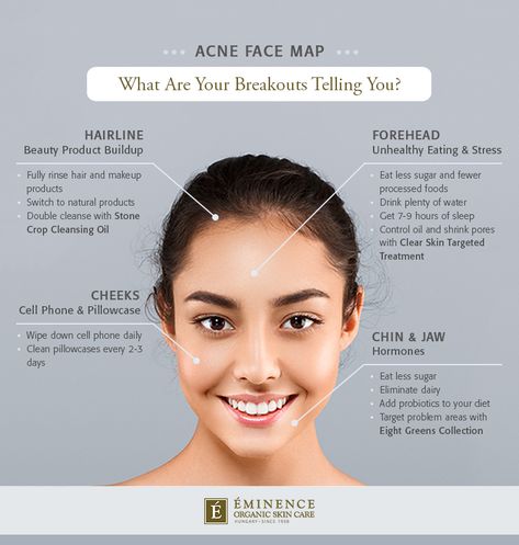 What are your breakouts telling you? Here's how to crack the code with a face map: Doterra Acne, Gesicht Mapping, Acne Chart, Acne Face Map, Face Map, Map Infographic, Face Mapping Acne, Forehead Acne, Eminence Organic Skin Care