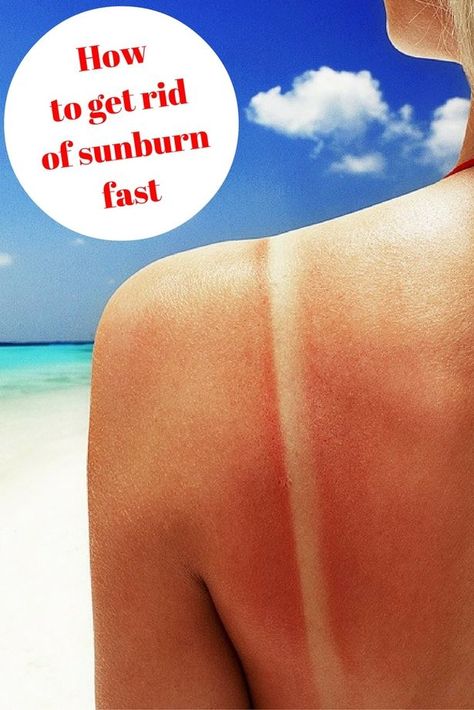 How to get rid of sunburn fast if you've overdone it in the heatwave How To Get Rid Of A Sunburn Fast, Sunburn On Face, Best Sunburn Relief, Sunburn Face, Sunburn Blisters, Remedies For Sunburn, Get Rid Of Sunburn, Sunburn Peeling, Natural Remedies For Sunburn