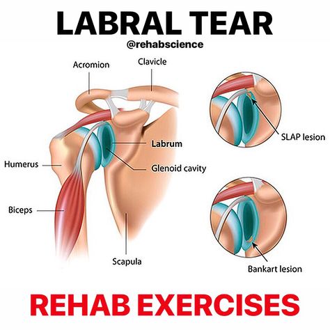 6,100 Likes, 240 Comments - Dr. Tom Walters (@rehabscience) on Instagram: “💥LABRAL TEARS💥 ---------- 🔎Labral tears can result in shoulder instability (not everyone), which…” Labral Tear Shoulder, Shoulder Rehab Exercises, Shoulder Anatomy, Rehab Exercises, Shoulder Dislocation, Shoulder Rehab, Gross Anatomy, Shoulder Exercises, Shoulder Surgery