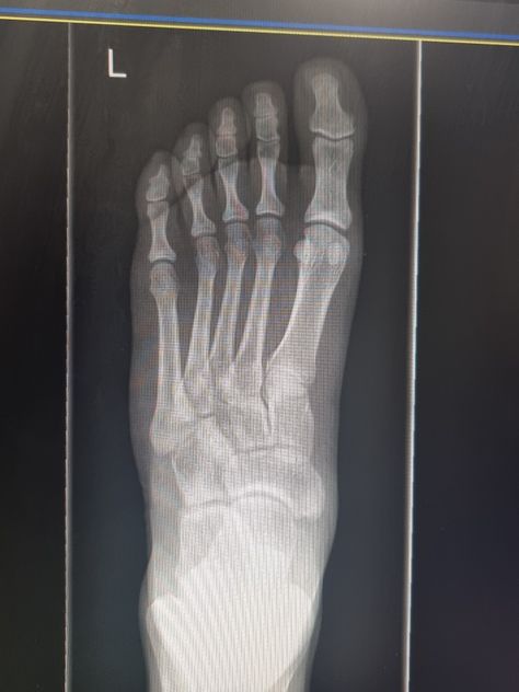 my foot! xray and no broken bones Broken Bones X Ray, Xray Art, Broken Foot, X Ray, Art Inspo, Body Care, Bath And Body, Bones, Medicine