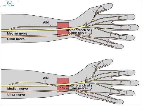 Ulnar nerve : Course, Motor, Sensory & Common Injuries » How To Relief Cubital Tunnel Syndrome, Ulnar Nerve, Median Nerve, Peripheral Nerve, Nerve, Plexus Products, Quick Saves