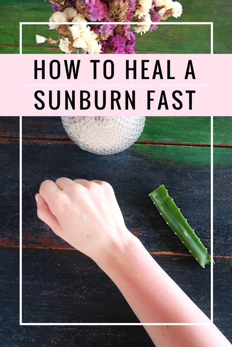 The Best Ways To Treat A Sunburn What Helps With Sunburns, How To Treat A Sunburn Fast, After Sunburn Care, Sunburn Relief Instant Diy, Treating Sunburn, Heal Sunburn Fast, Heal Sunburn, Skin Burns, How To Get Rid Of Pimples