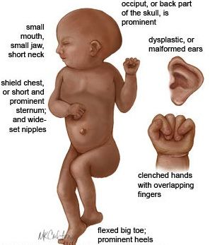 edwards syndrome - Google Search Medical Horror, Anatomy Diagrams, Edwards Syndrome, Sonography Student, Medical Sonography, Diagnostic Medical Sonography, Child Nursing, Neonatal Nurse, Daisy Wallpaper